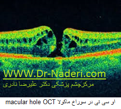 macular hole OCT او سی تی در سوراخ ماکولا 